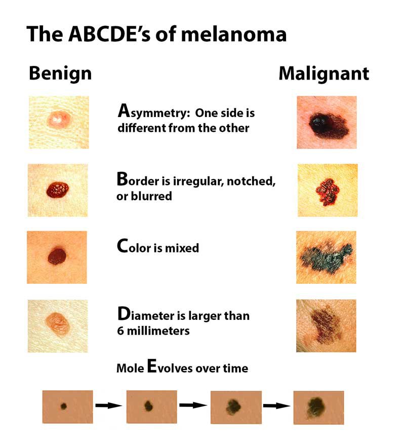  So I Have This Mole How To Identify Skin Cancer And How To Prevent 